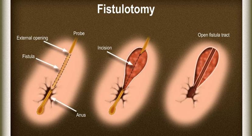 /fistulectomy-1.jpg