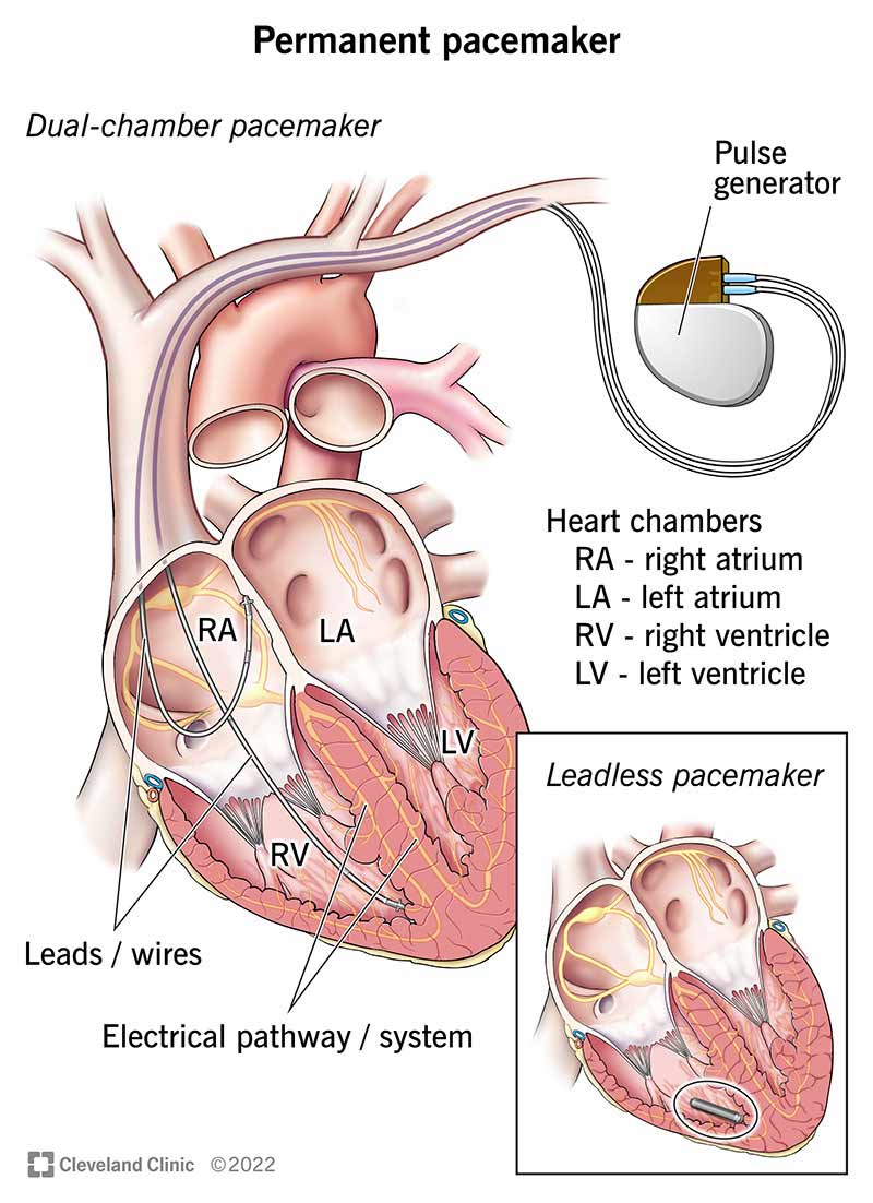 /pacemaker-1.jpg