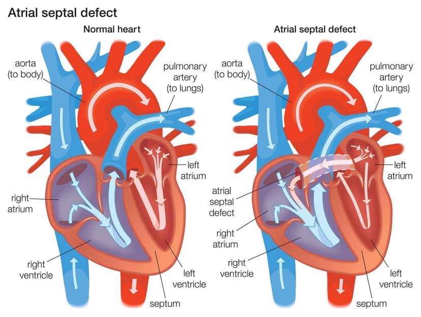 /septal-defect-1.jpg