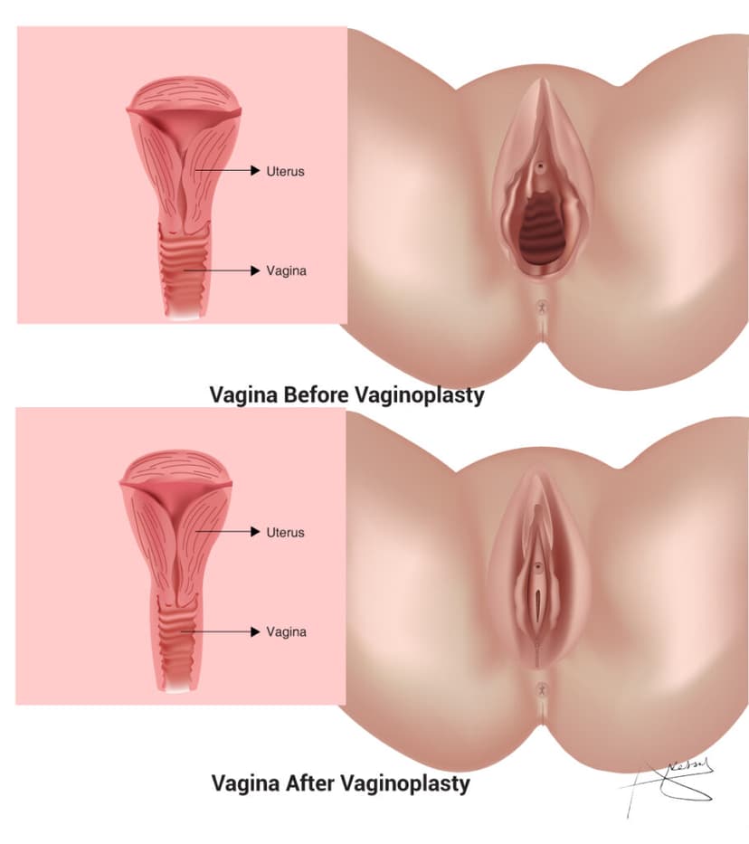 /vaginoplasty-1.jpg